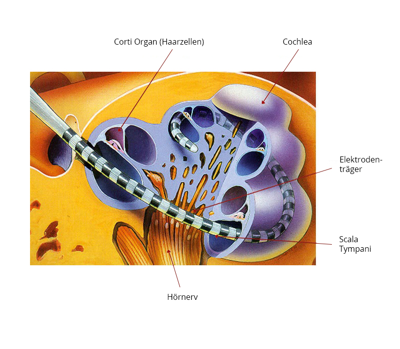 Cochlea und Elektrodenträger
